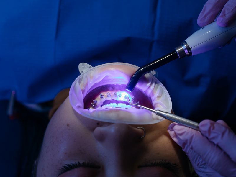 UV light curing a tooth-colored composite dental filling at Englewood Dentistry