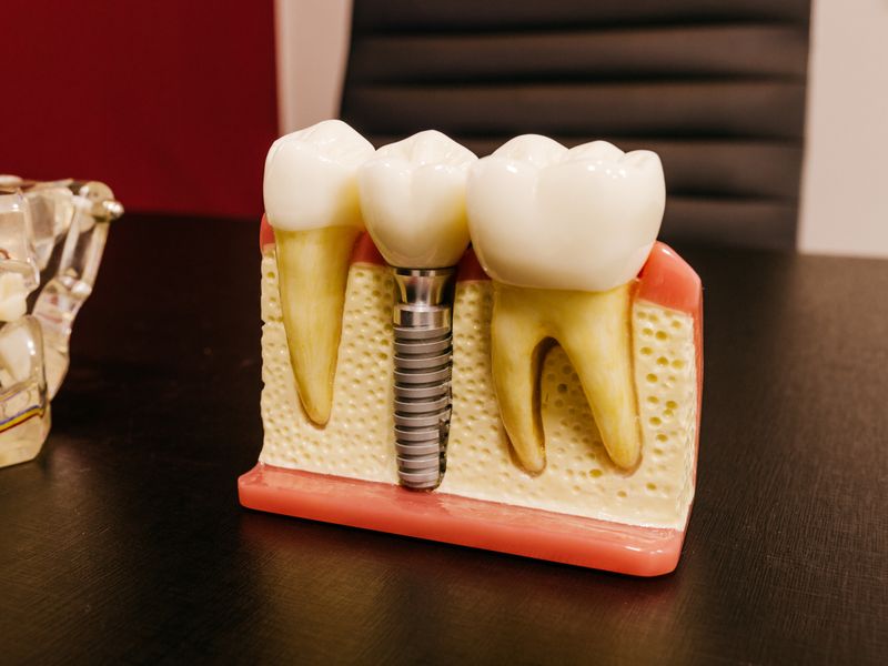 Dental implant model showing titanium post and crown at Englewood Dentistry